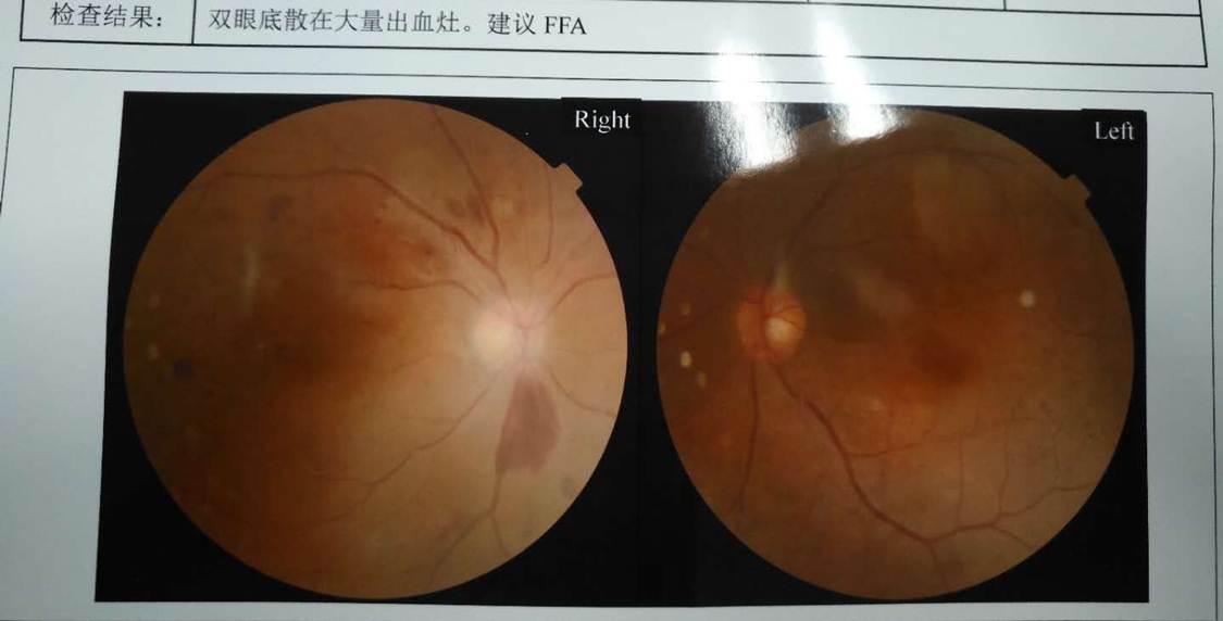 眼底出血.jpg