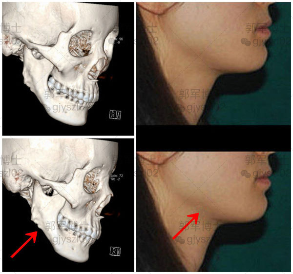 第二下颌角修复案例