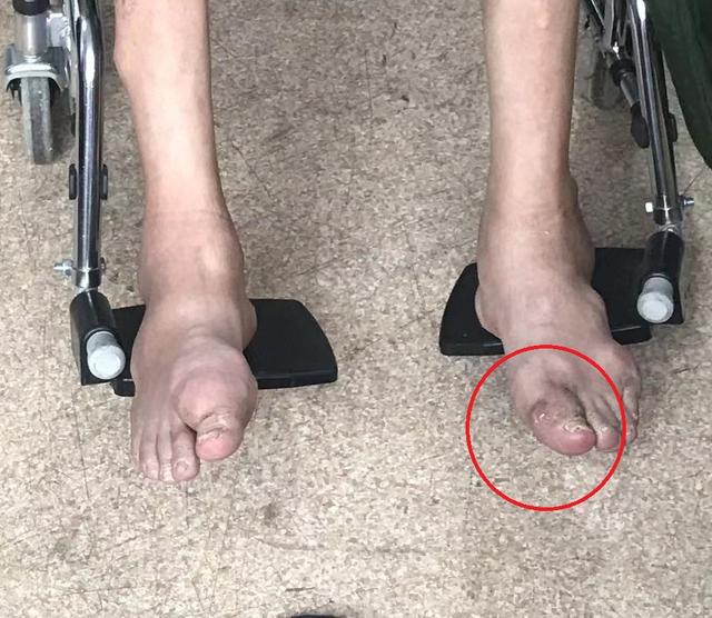 清洗创面→生理盐水彻底冲洗干净,尽可能清除黄色坏死组织和尿酸结石