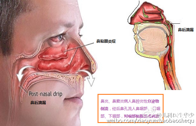 鼻后滴漏综合征是什么？