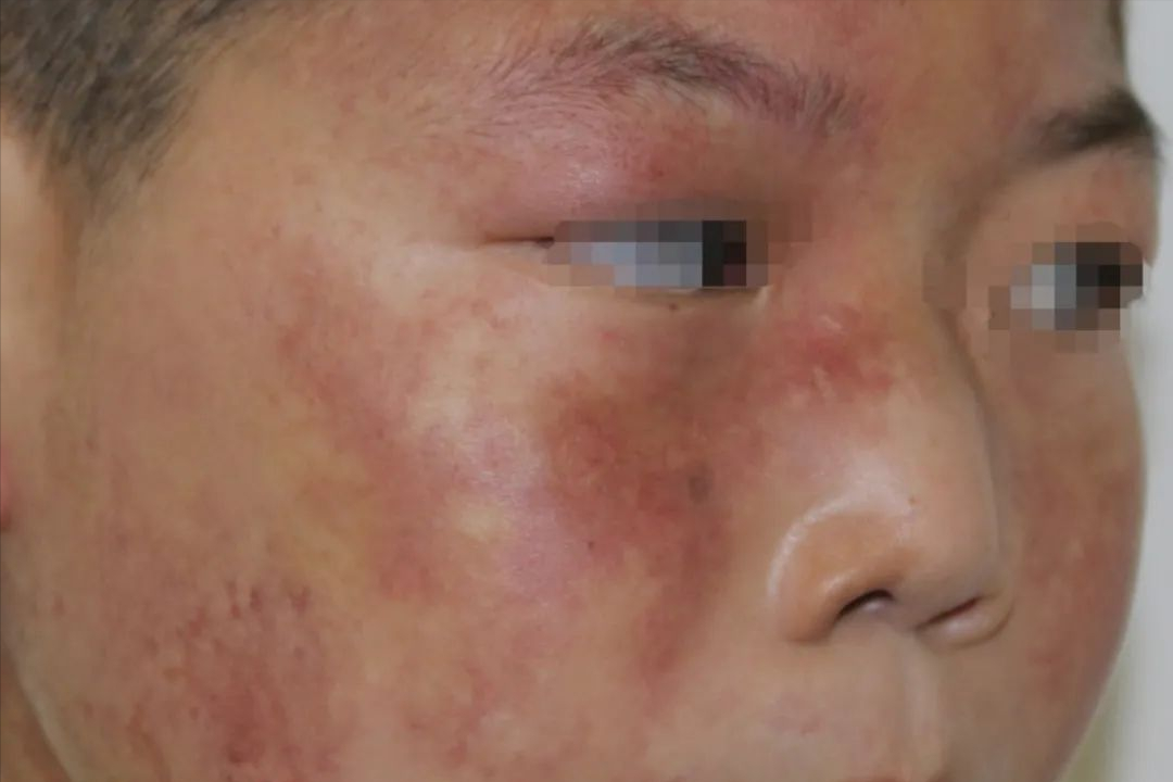 可消退的胎记别成为认亲的遗憾