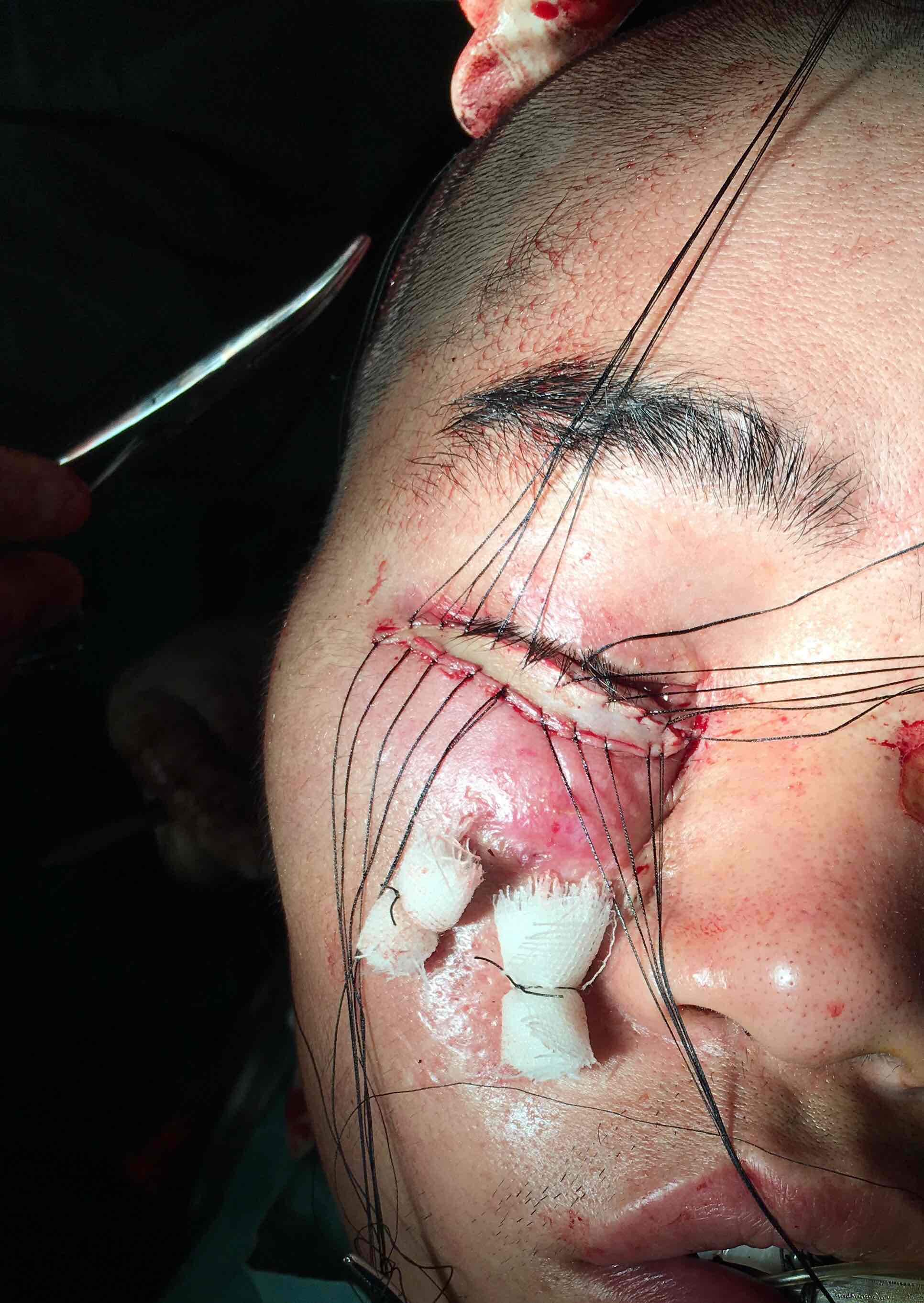 一例严重爆炸伤造成的面部凹陷的矫正
