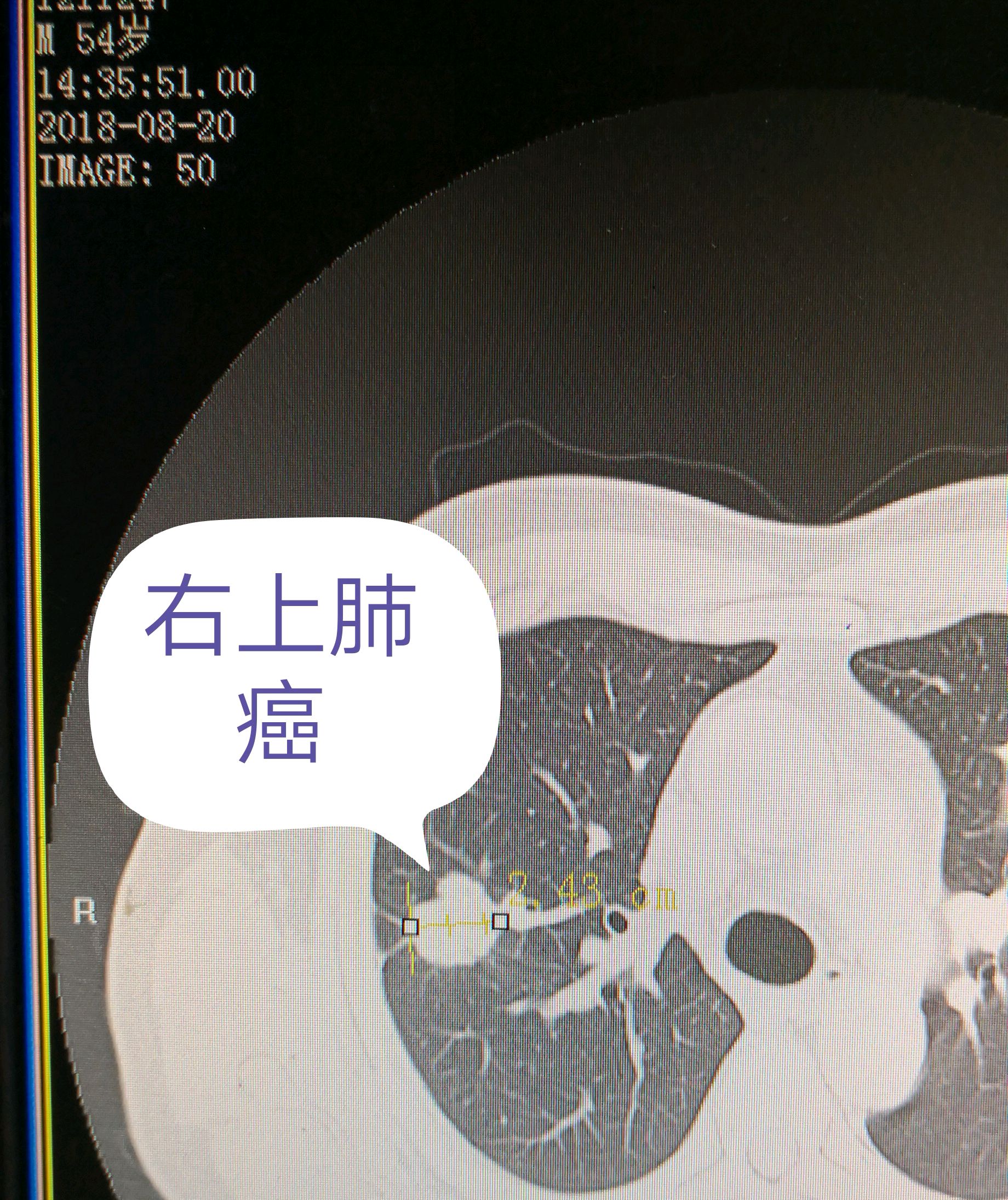 肺癌是中国城市和农村发病率和死亡率第一的恶性肿瘤,也是全世界发病