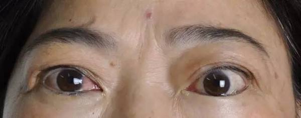 上睑外翻(退缩),显得眼神紧张甚至惊恐不安