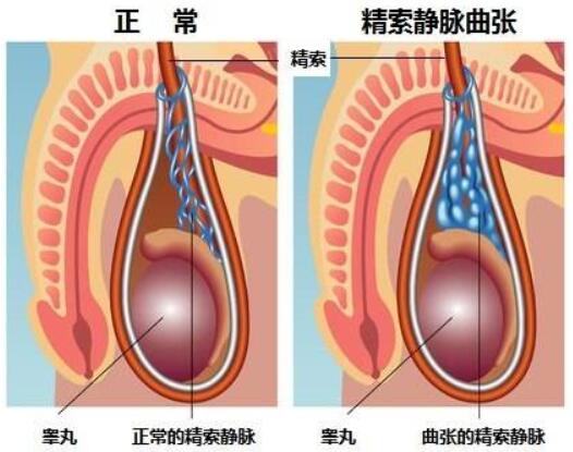 冷敷等方法,对于较重的精索静脉曲张,如精子数减少或有睾丸萎缩