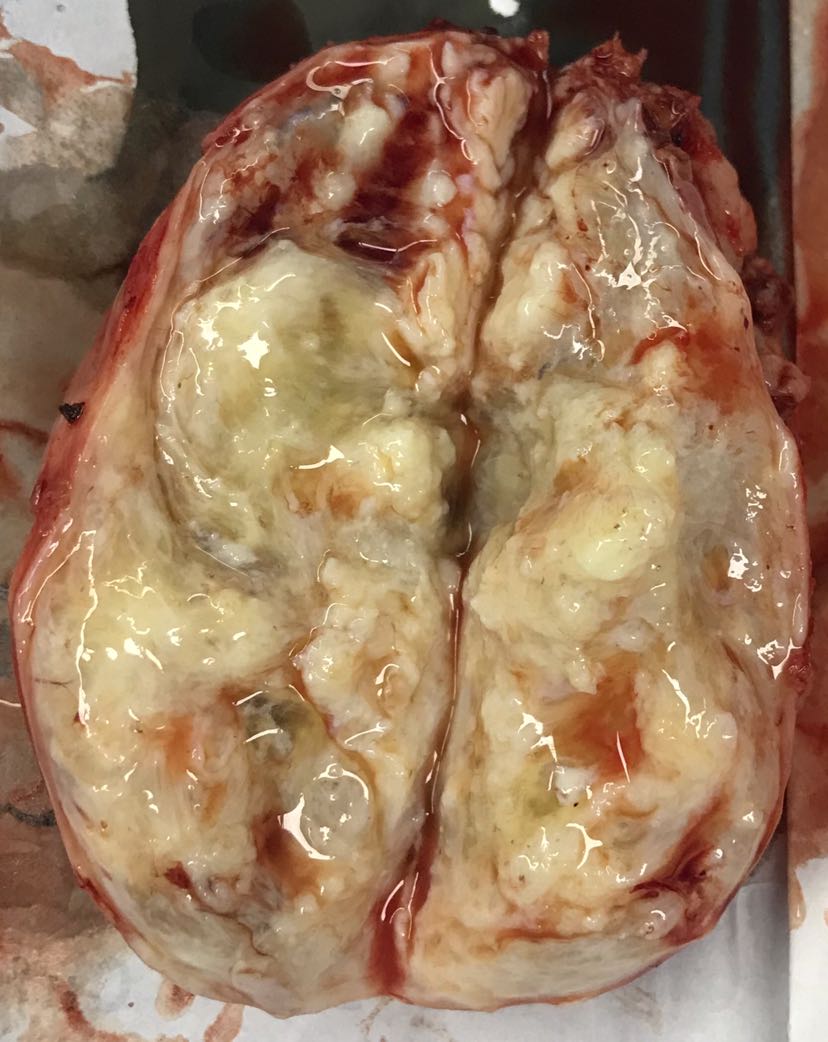 子宫后壁肌瘤图片