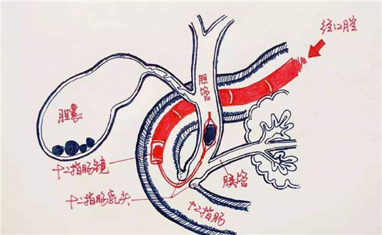有哪些疾病需要使用ercp治疗?