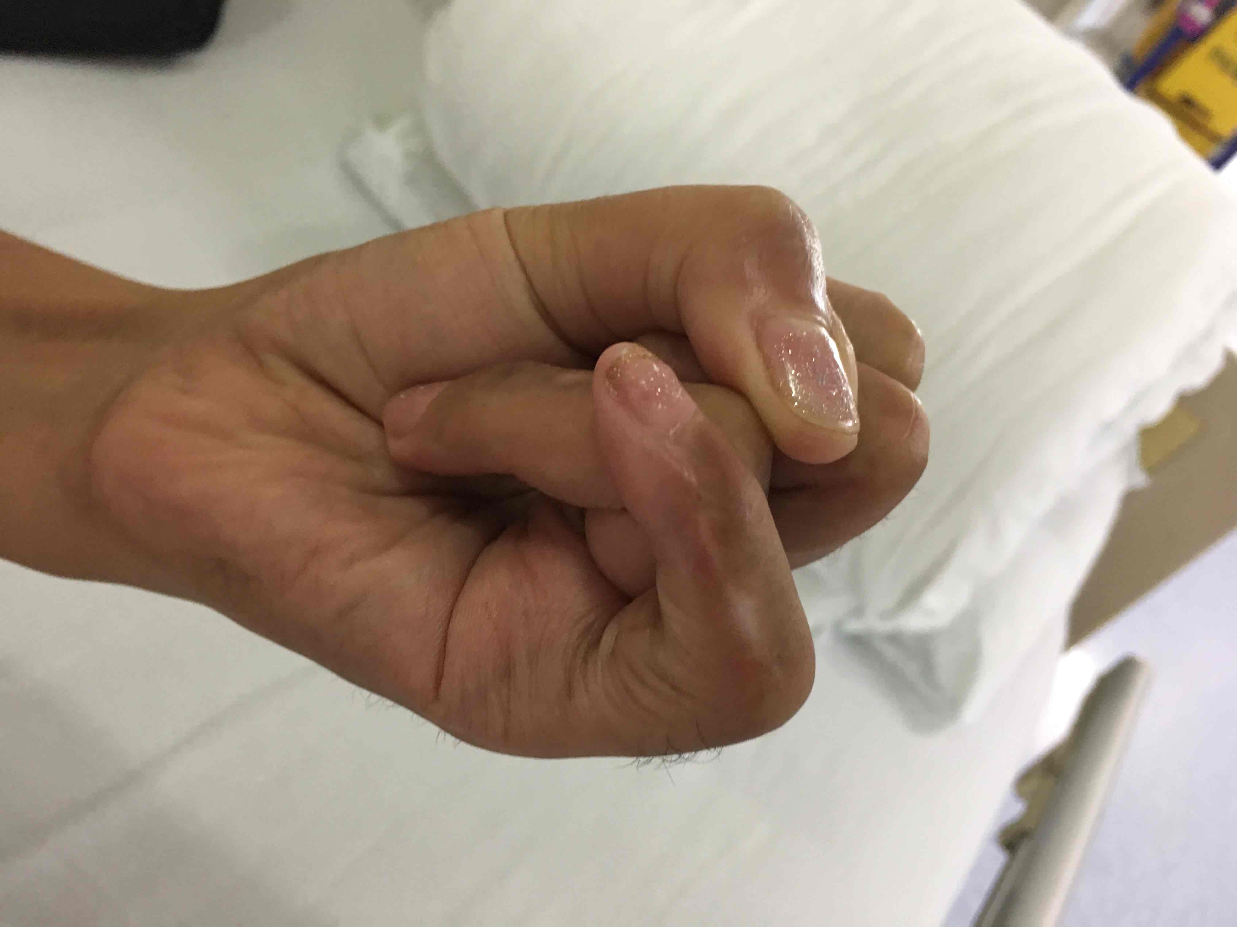 外伤导致的手指掌指关节挛缩的手术治疗效果