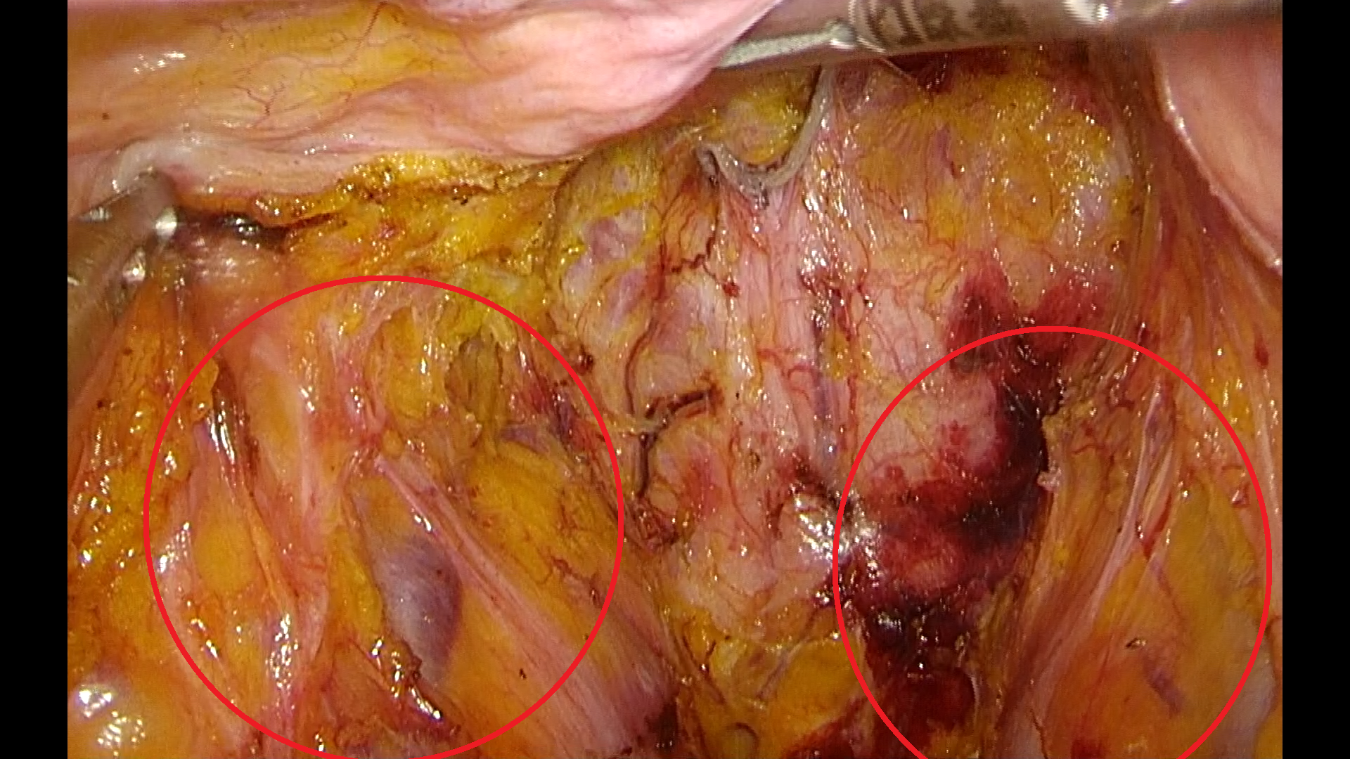 从"干撸枪没子弹"谈谈腹腔镜直肠癌根治术中的神经保护
