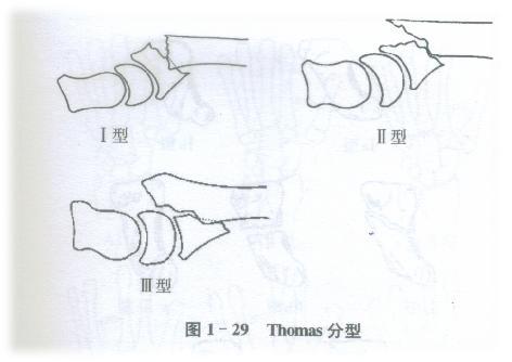 橈骨遠端骨折詳細解析與方法提供,及相應個人見解!