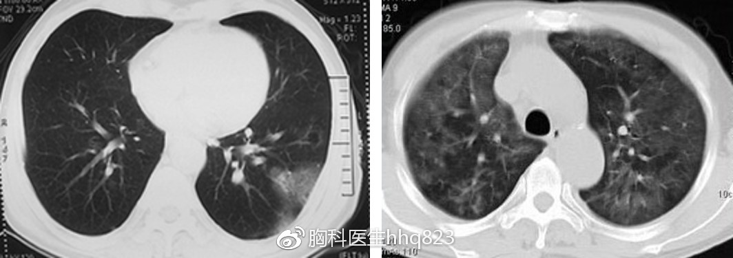 肺磨玻璃結節是如何形成的