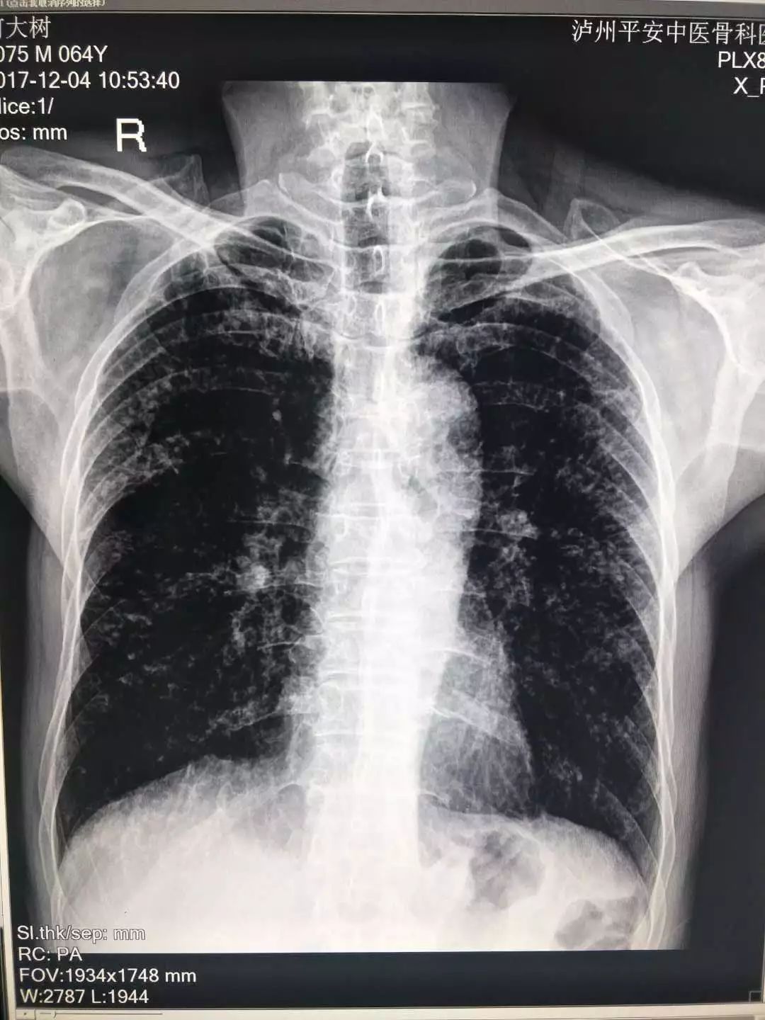 矽肺病ct图图片