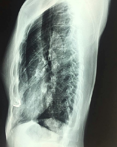 女性漏斗胸患者的第三次手术成功