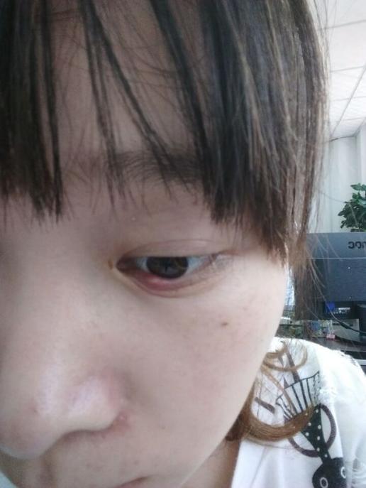 化妆品进入眼睛以后发炎感染了,后面疼痛,用了氧氟沙星滴眼液,现有?