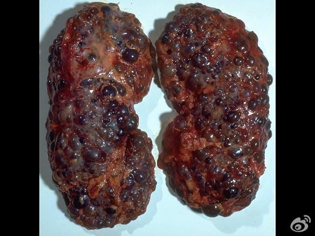 肾长了水泡不用惊慌但必须重视