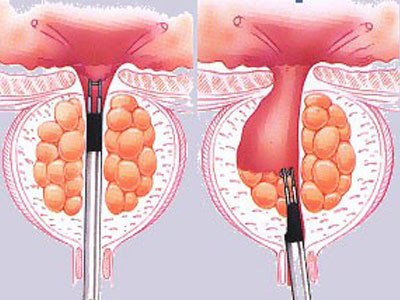 健康科普:为什么前列腺增生对中老年人"情有独钟"?