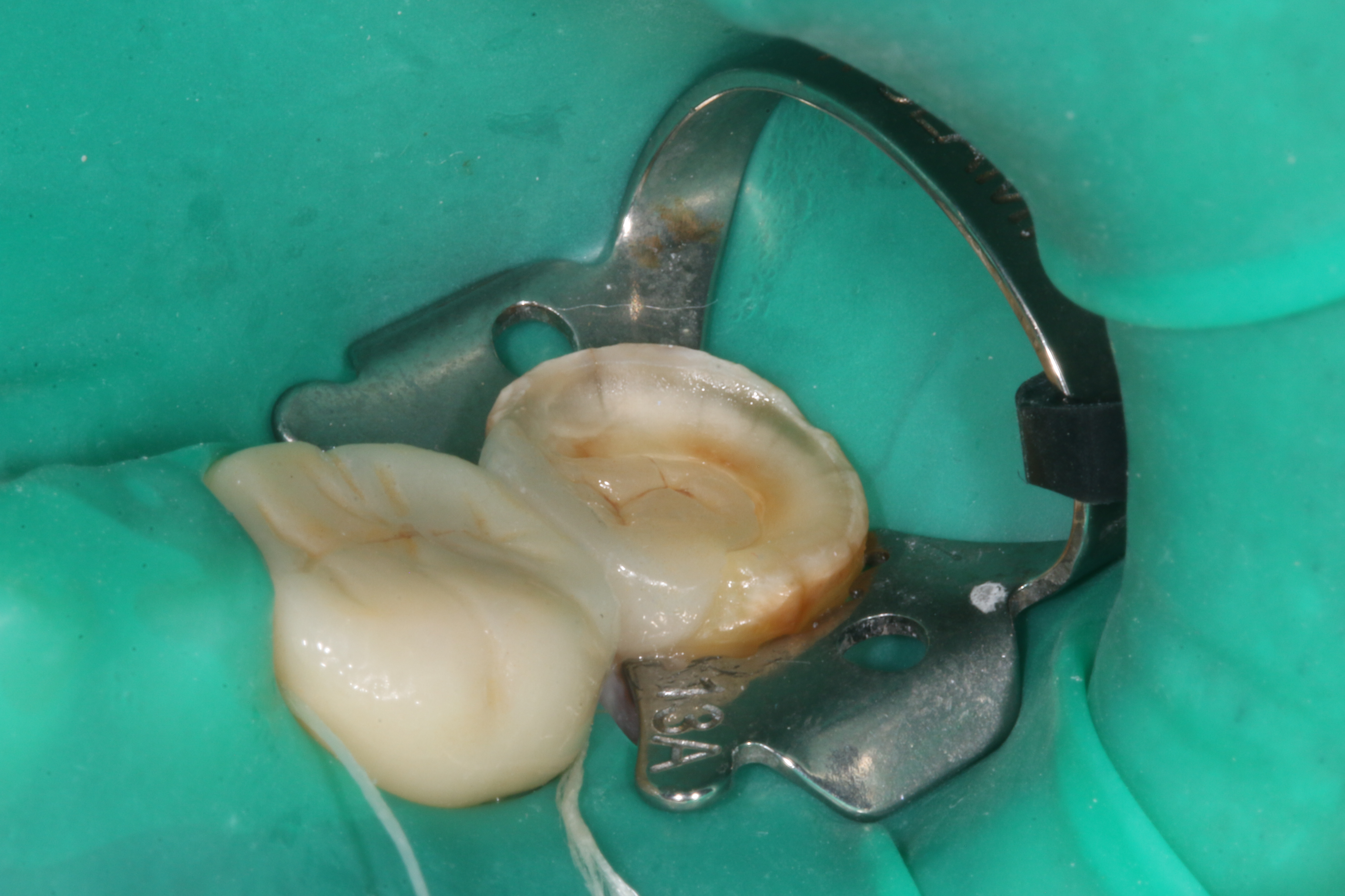 牙齿嵌体修复图片