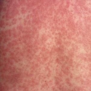麻疹样或猩红热样红斑型药疹1临床表现4过敏反应性机制引发的药疹常有