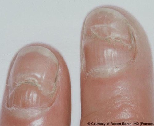 指甲上这样的横沟被我们称为"beaus lines"博氏线正常儿童的指甲是