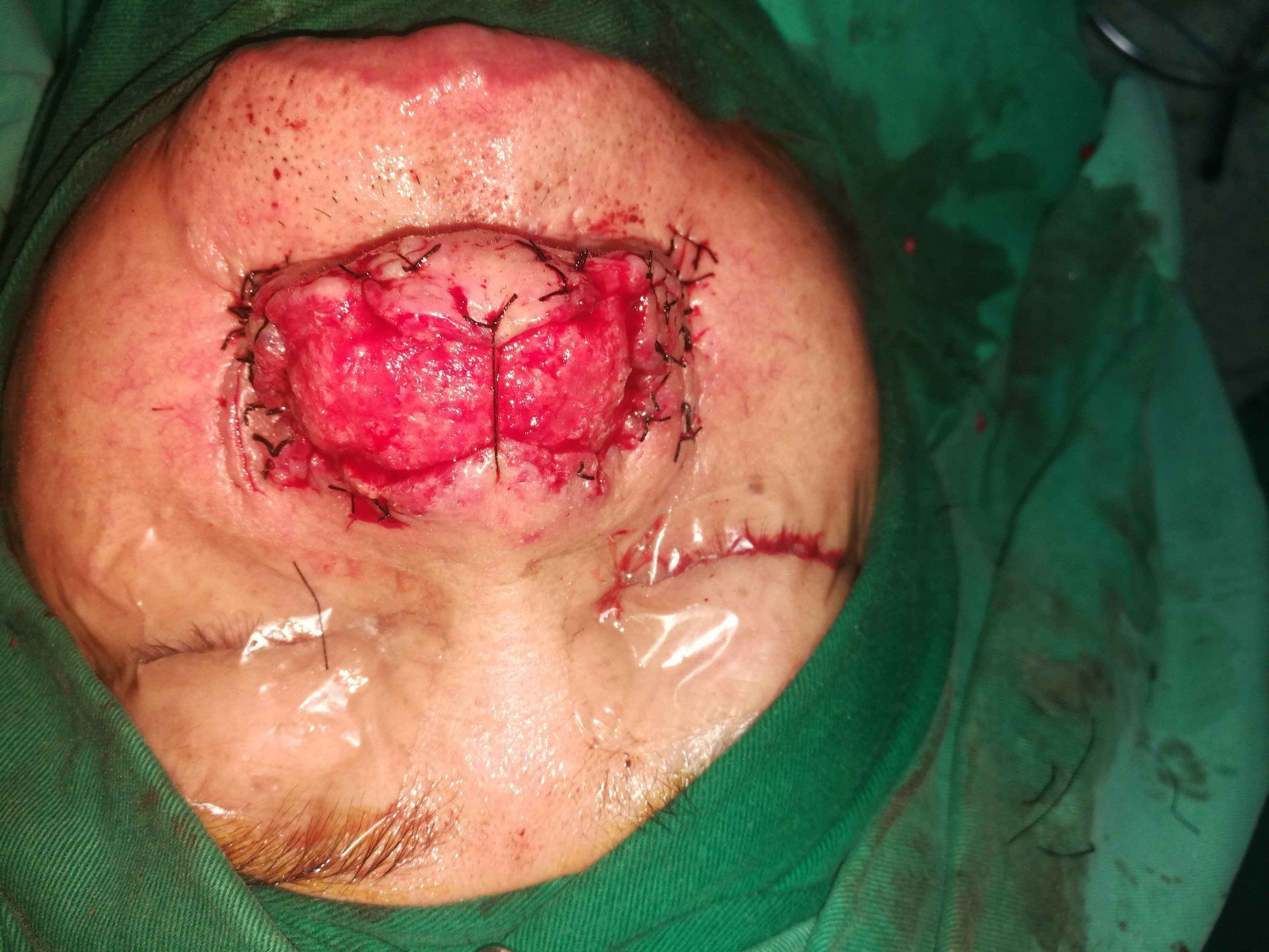 手术成功治疗一例严重老年酒渣鼻患者的经验介绍