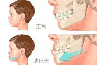 2,兜齿(地包天)牙齿矫治带来的改变相对于手术会更加自然,因为矫正是