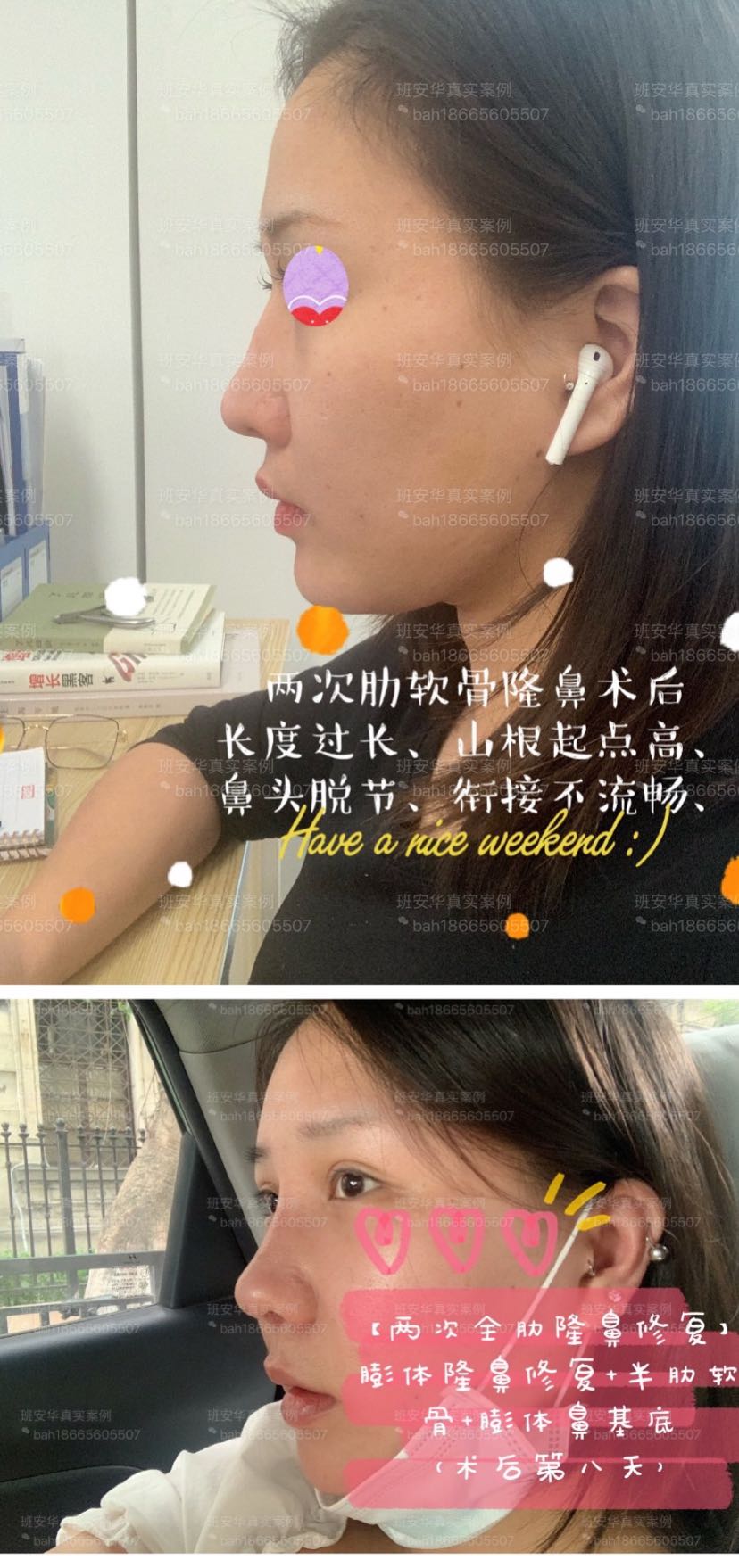 如果做过隆鼻的人 可以去打拳击比赛吗 隆鼻术后歪不歪看天意 班安华 爱问医生