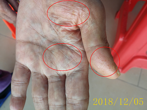 废话不多说,直接上图:汗疱症,在百科里又称为出汗不良性湿疹,为一种