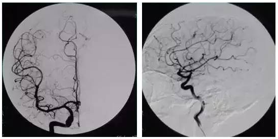 五分钟看懂全脑血管造影
