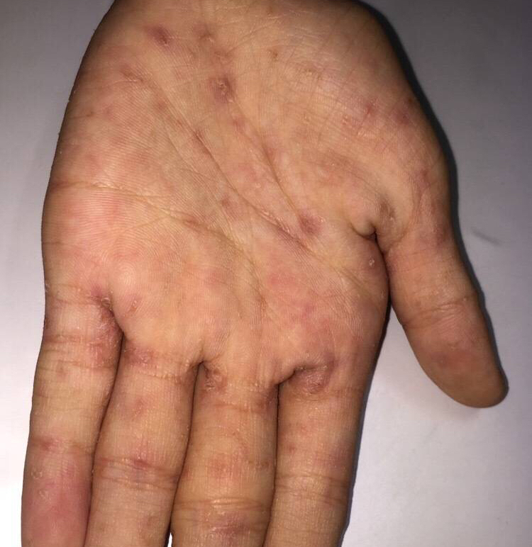 宝宝被传染了疥疮,大都是父母的疏忽大意导致的!