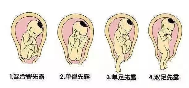 顾名思义,就是指宝宝的臀部朝下,是常见的异常胎位之一,单胎的发生率