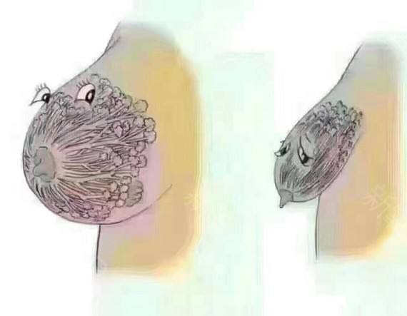 乳房下垂干瘪手术切皮图片
