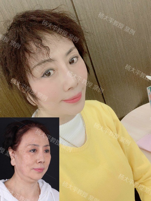 【诊间日记】面部综合年轻化案例分析