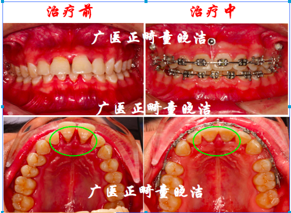 牙齿松动是因为矫了牙吗?