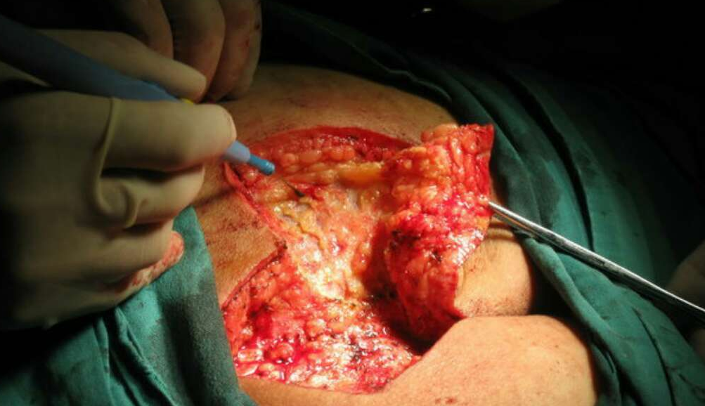 "吉普车病"——藏毛窦_孟勇_主任医师_爱问健康