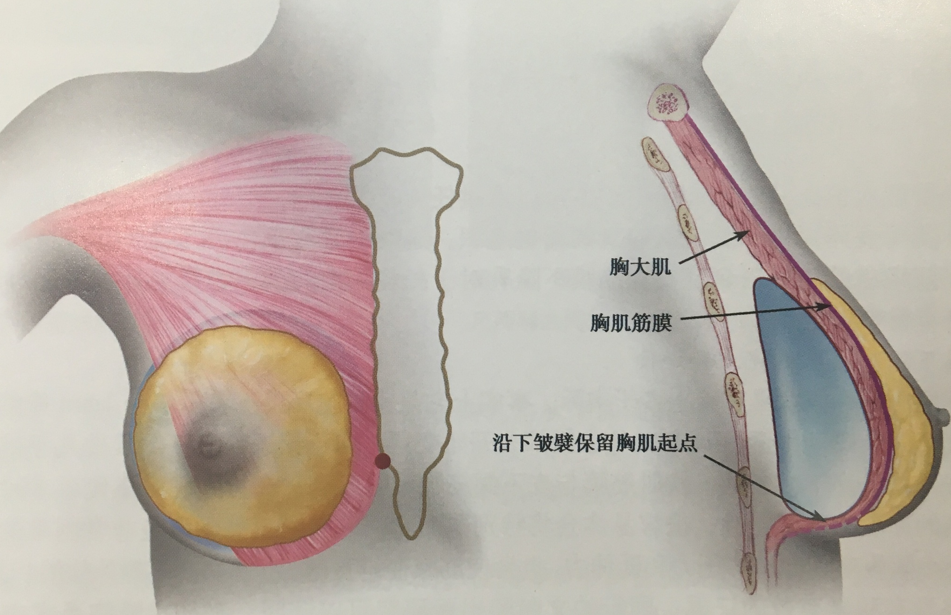 的附着点,优点为:可以减少包膜李缩的发生率及避免对乳房形象的干扰