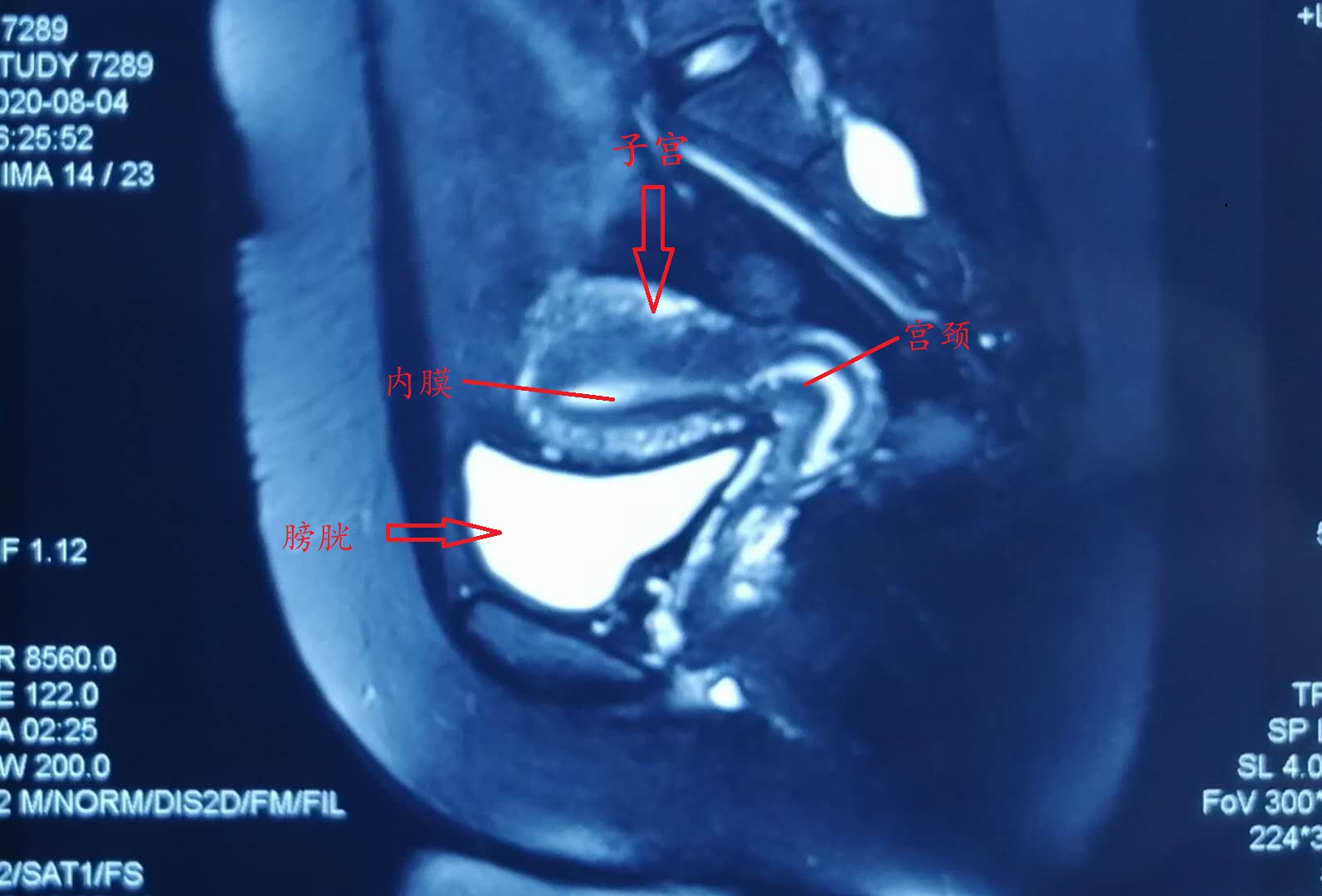 子宫MR解剖图片