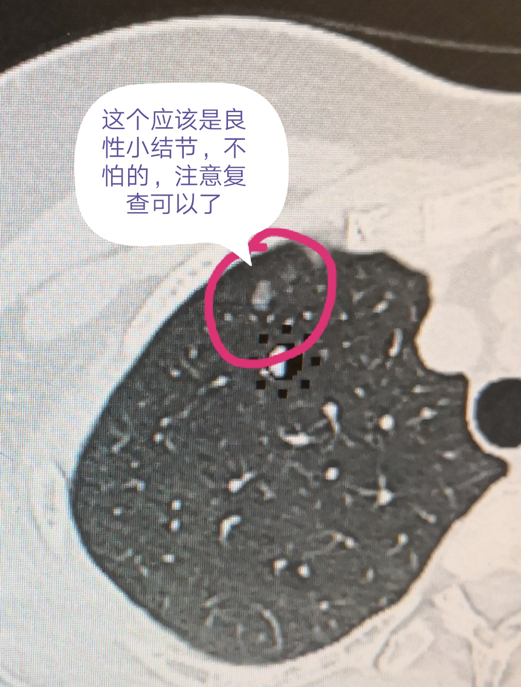 这个肺小结节不要紧
