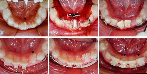 儿童牙齿矫正,你想知道的都在这里!