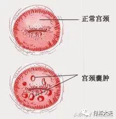 美容院说花6800元可以治愈宫颈纳囊去不去