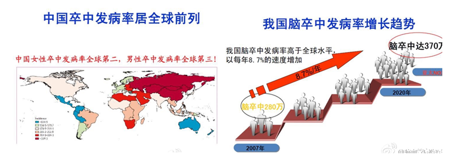 高发病率:我国脑卒中发病居于全世界前列,我国年发病率120-180/10万