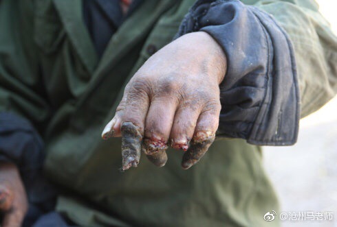 向现代医学发起挑战——中医50天成功治愈重症血栓闭塞性脉管炎_马宝