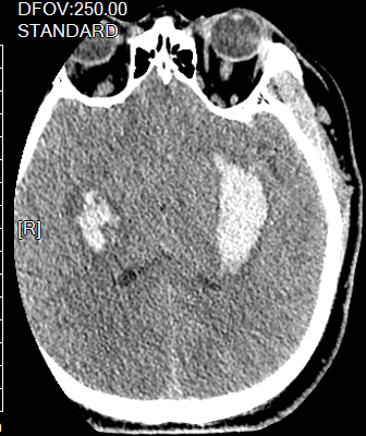 形形色色脑出血-邢学民副主任医师-爱问医生