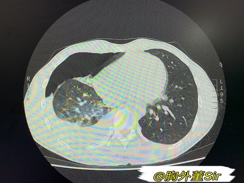 小老弟,这可不好玩.--血气胸