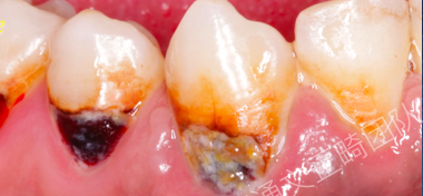 被胃酸腐蚀过的牙齿图图片