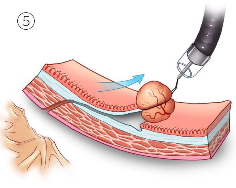 做微创腹腔镜胆囊手术到底需要多少孔?