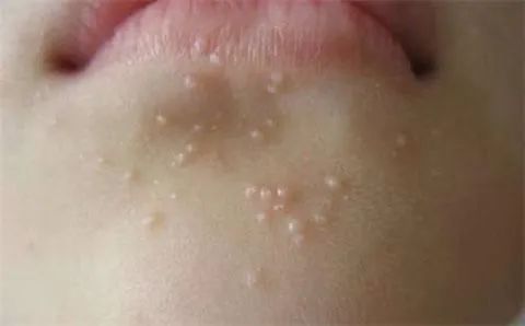 身上长了鼠乳状的小疙瘩很肯是传染性软疣作祟