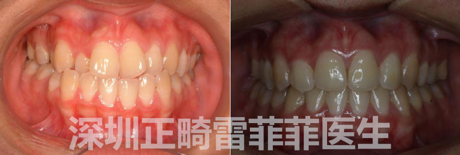 不对称的牙齿反颌反颌:下牙咬合在上牙的外面,影响咀嚼功能,面部肌肉