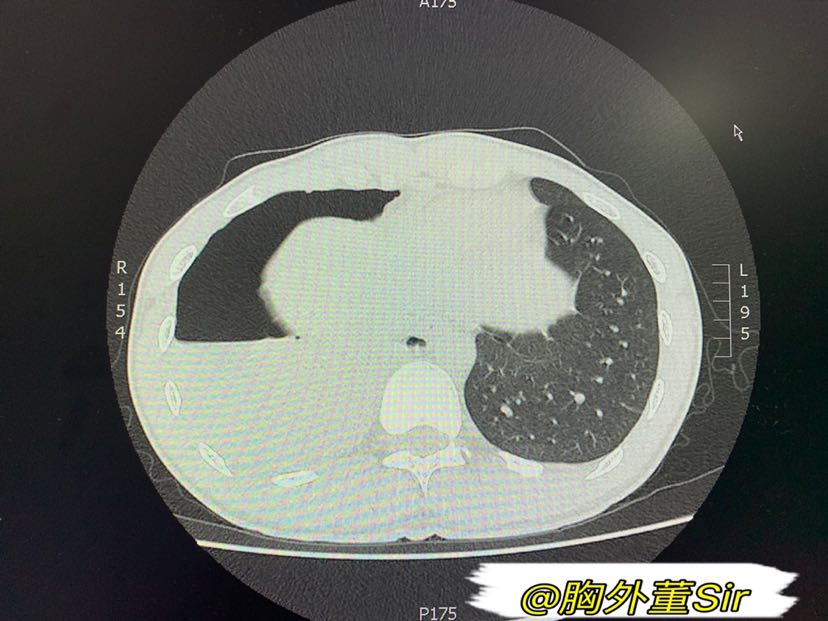 血胸胸片典型图片图片