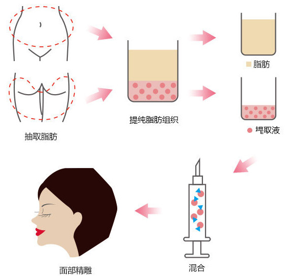 自体脂肪颗粒注射抚平川字纹