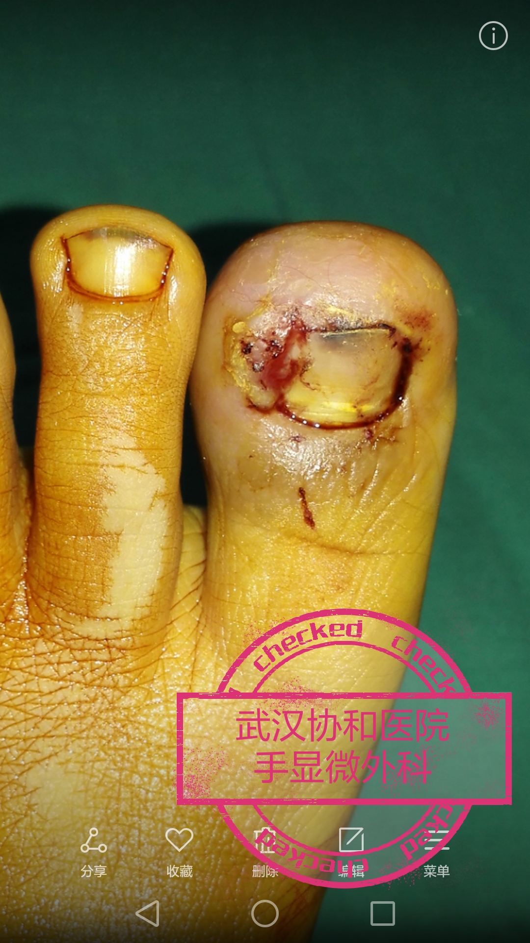 嵌甲性甲沟炎的治疗